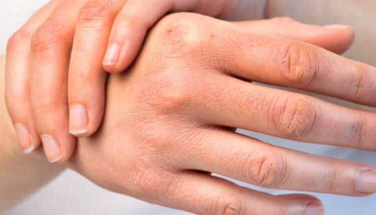 El Kuruluğunun Nedenleri? Kuru Eller İçin Maske Tarifi