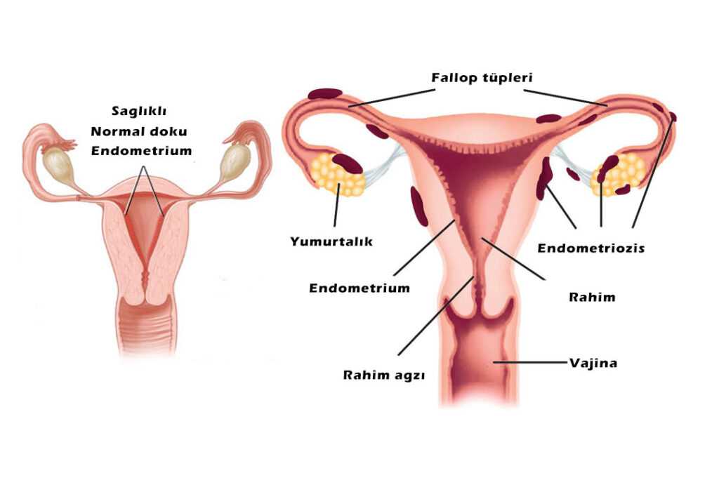 Endometrium Rahim İç Zarı Kanseri Belirtileri ve Tedavisi Sağlık Rehberi