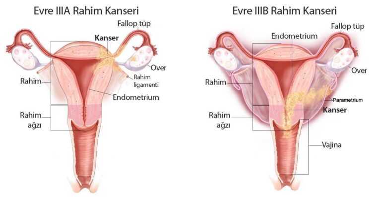 Endometrium (Rahim İç Zarı) Kanseri Belirtileri ve Tedavisi