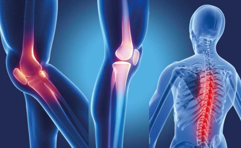 Kemik Erimesi (Osteoporoz) Nedir, Belirtileri, Tedavisi