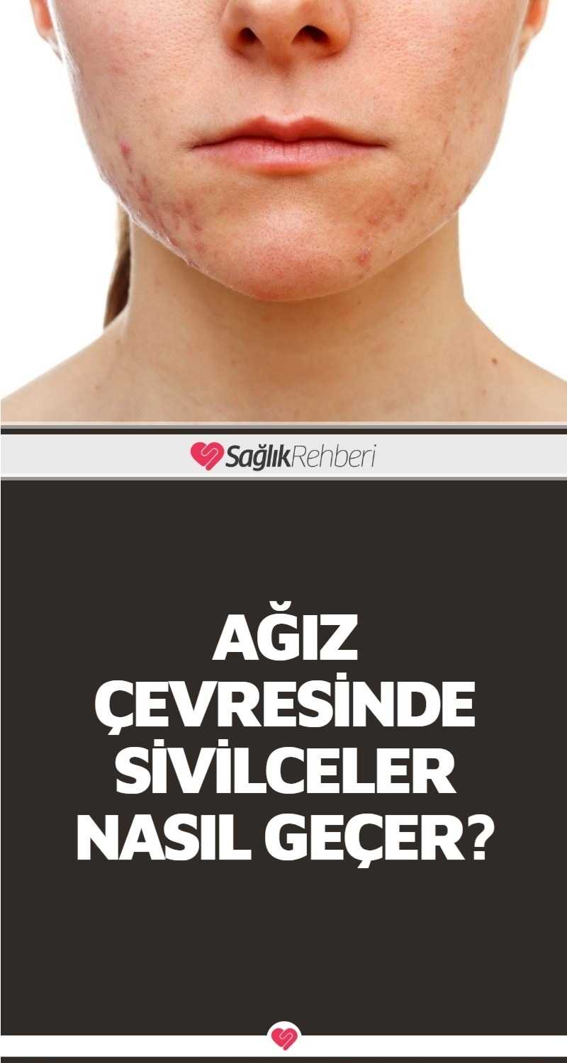 Ağız Çevresinde Sivilceler Nasıl Geçer?