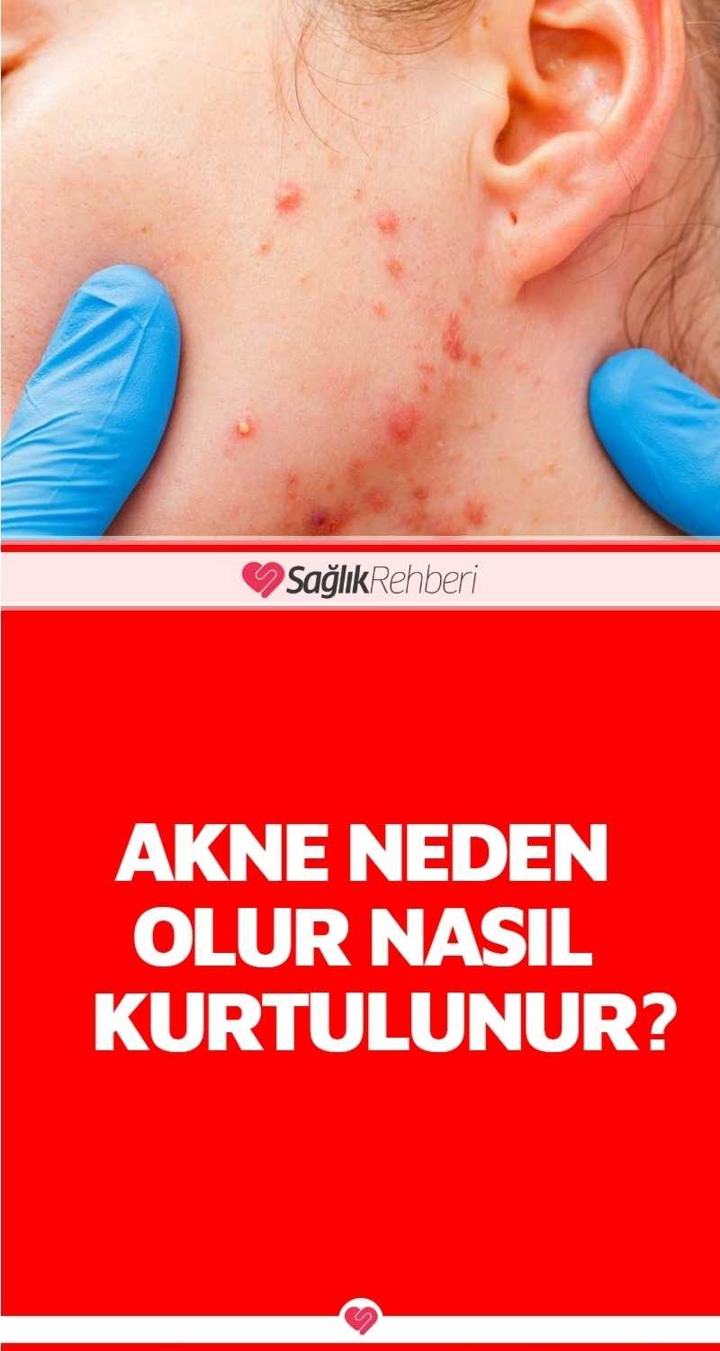 Akne Neden Olur Nasıl Kurtulunur?