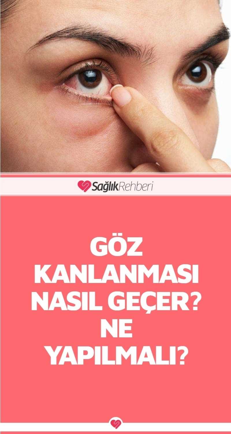 Göz Kanlanması Nasıl Geçer? Ne Yapılmalı?