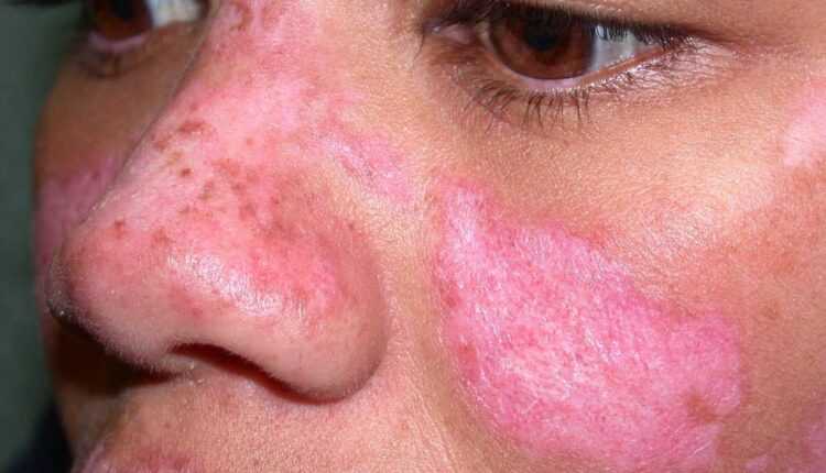 Lupus Hastalığı Nedir ve Nasıl Tespit Edilir?