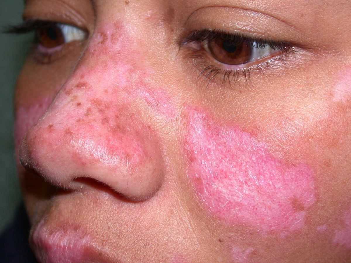 Lupus Hastalığı Nedir ve Nasıl Tespit Edilir?