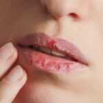 resized_Ali-Ghahary-Dry-Chapped-Lips-660×330-1-1280×720